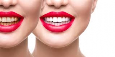 Èñêðÿùà óñìèâêà, ïðåêðàñíè áåëè çúáè